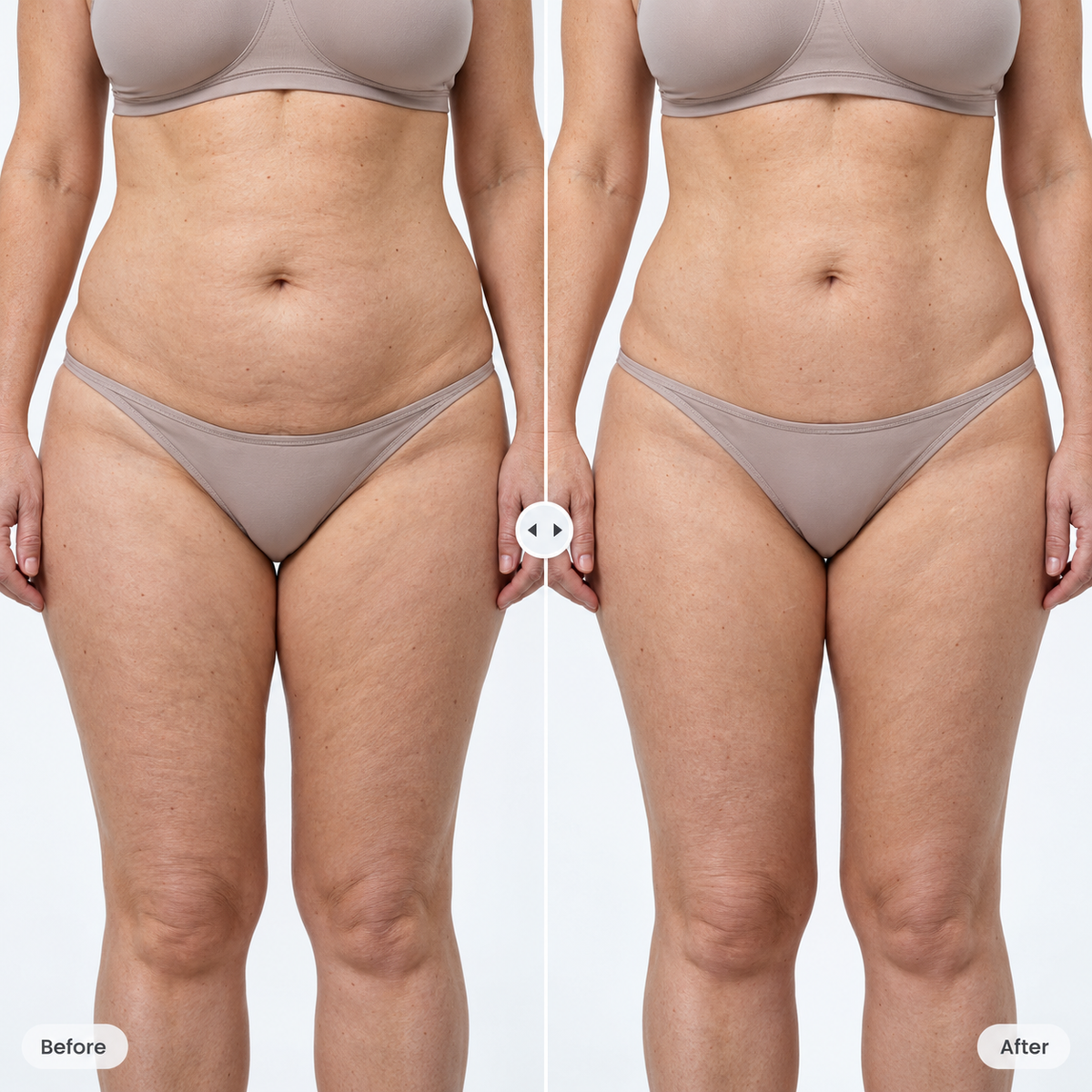 Authentic before and after body contouring results on the abdomen after consistent use of the Litevisage system.